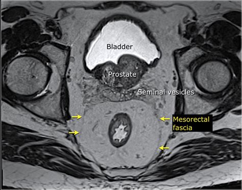 Radiotherapy Dictionary: Mesorectal fascia (MRF)