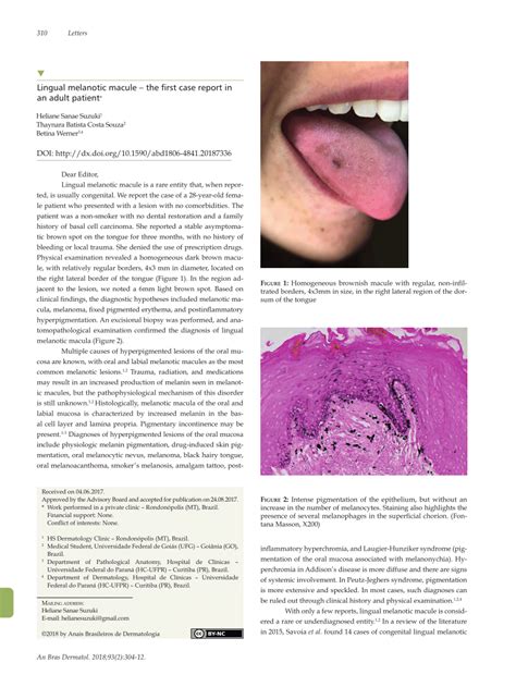 (PDF) Lingual melanotic macule - the first case report in an adult patient