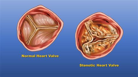 Study: Race and Ethnicity May Impact Prevalence and Treatment of Heart ...