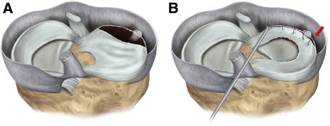 Editorial Commentary: Saucerization Is Superior to Total Meniscectomy ...