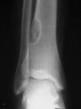 Fibrous Cortical Defect and Nonossifying Fibroma Imaging: Practice ...