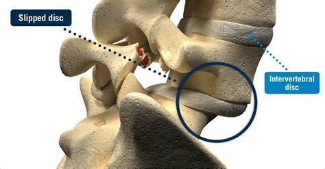 Slipped Disc - USA Spine Care - Laser Spine Surgery