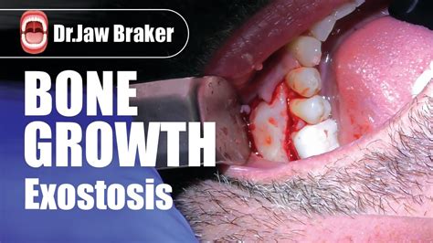 Exostosis - Bone Growth - YouTube