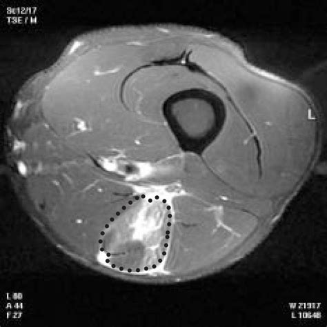 T2 axial view. Semitendinosus muscle (large) injury. The vertical line ...