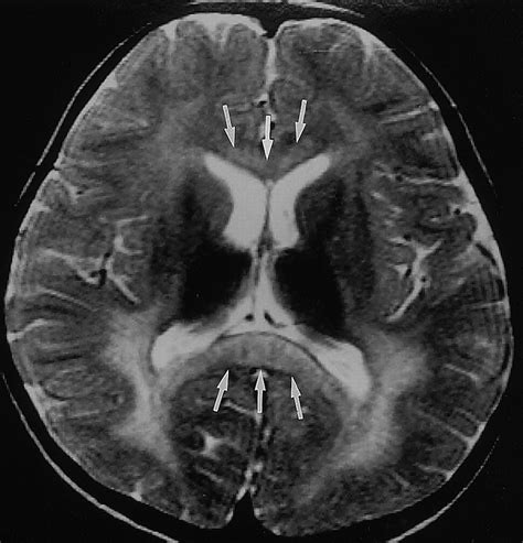 Leukodystrophy in Children: A Pictorial Review of MR Imaging Features ...