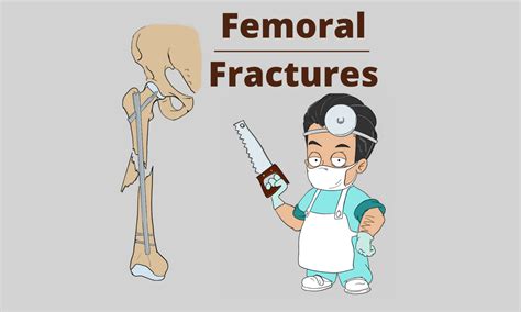 Femoral Fractures: No Time To Lose - Pro doctor