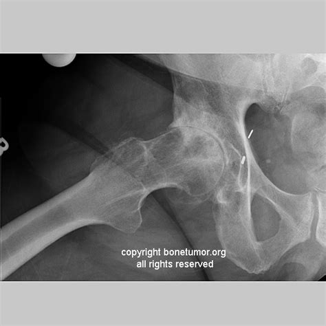 Subchondral cyst | BoneTumor.org