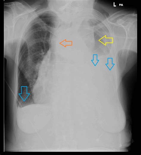 Aortic dissection x ray - wikidoc