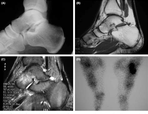 bone marrow edema | Semantic Scholar