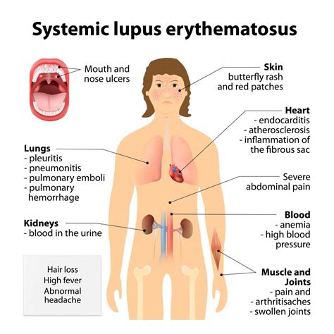 Can Lupus Cause Swollen Face - Diseases Club Center3