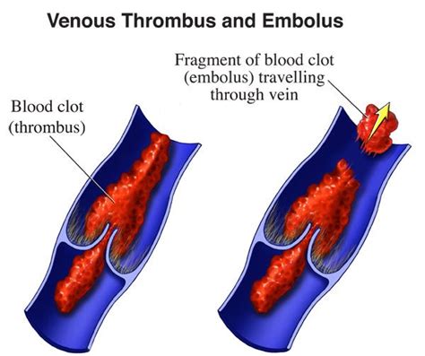 Treatment for Blood Clots in New Jersey | Heart, Vascular, Thoracic