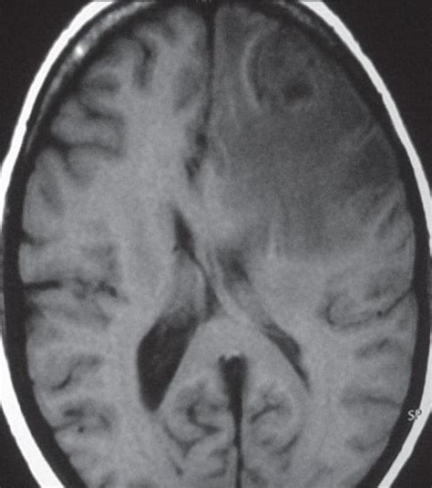 Brain metastasis from papillary carcinoma of thyroid gland - Journal of ...