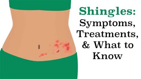 Shingles Symptoms Treatment