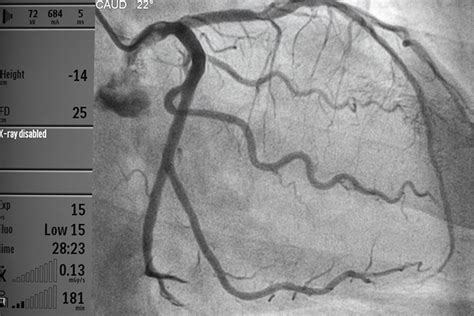 Angiography for Cardiac Arrest Survivors: No Need to Rush | MedPage Today