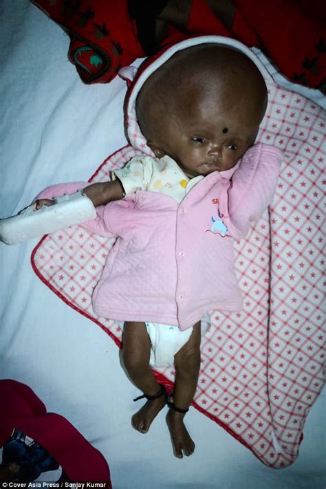 Indian baby's head tripled in size due to hydrocephalus | Daily Mail Online