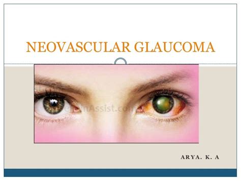 Neovascular glaucoma