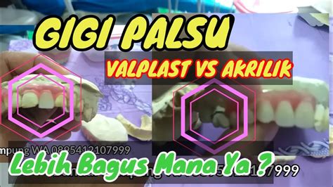 Review Gigi Palsu Valplast VS Gigi Palsu Akrilik - YouTube