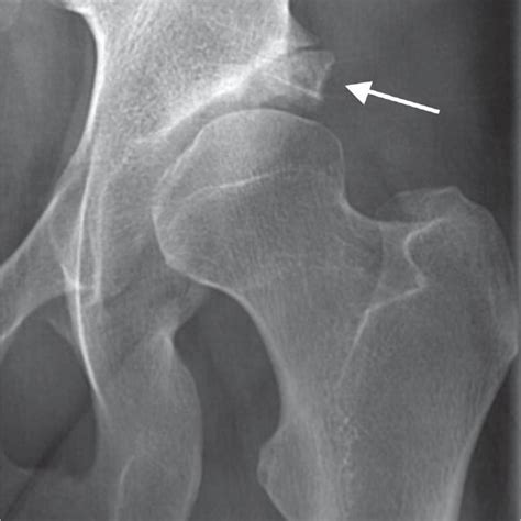 Ultrasound examination of the acetabular labrum. A. A normal labrum ...