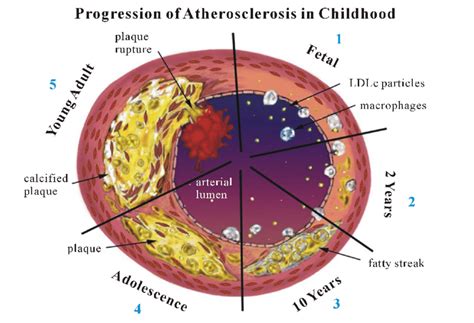 Atherosclerosis Diagram