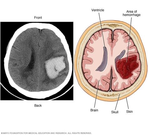 Brain AVM (arteriovenous malformation) - Symptoms and causes - Mayo Clinic