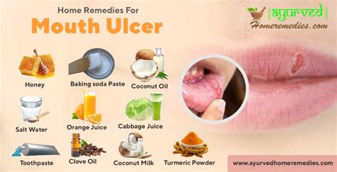 Home Remedies To Cure Mouth Ulcers | How To Get Rid Of Canker Sores ...