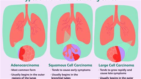 Lung Cancer Hyponatremia