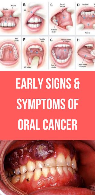 Early Signs & Symptoms of Oral Cancer - wellness magazine