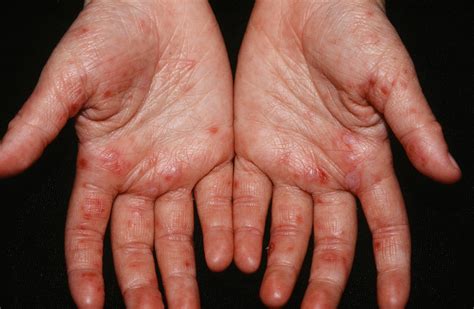 Pictures of Hand-Foot-and-Mouth Disease - HTQ