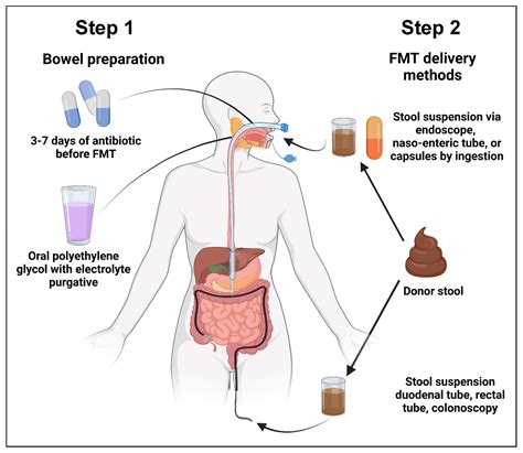 Cancers | Free Full-Text | Fecal Microbiota Transplant for Hematologic ...