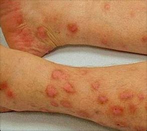 Prurigo Nodularis: Symptoms, Diagnosis and Treatment