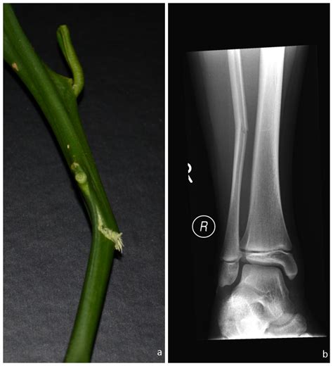 Greenstick Fracture