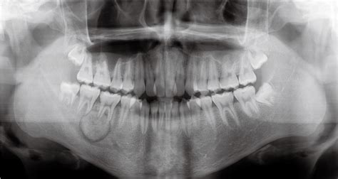 Figure 1 from Recurrent benign cementoblastoma: A case report and ...