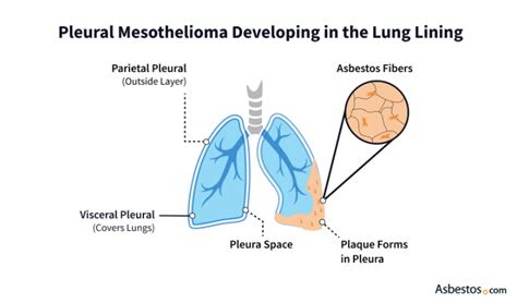 Malignant Pleural Mesothelioma: Life Expectancy & Symptoms