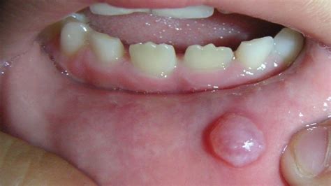 Mucocele | The Dental Arcade – Blog