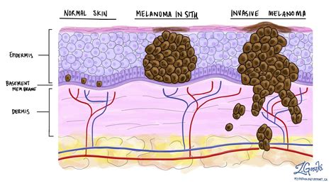 Melanoma in situ of the skin - MyPathologyReport.ca