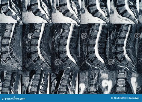 Diagnosis Of Pinched Nerve. Medical Health History Written With ...