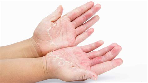 Allergic Contact Dermatitis: Prevention, Treatment, and How Can ...