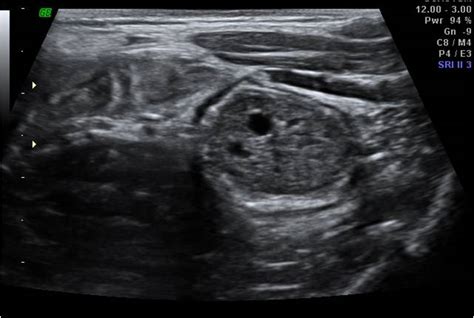 ‘DESCENDING COLONIC POLYP’- An ultrasound diagnosis - Sumer's Radiology ...