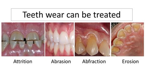 What is Tooth wear? - Leading Dental Clinic in Dubai - Best Dentist ...