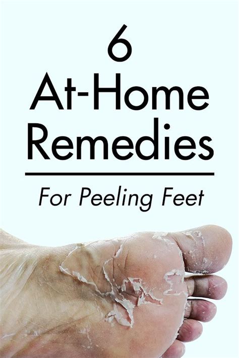 6 At-home Remedies For Peeling Feet | Dry feet remedies, Cracked feet ...