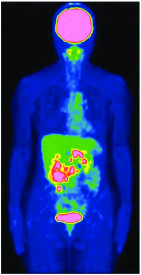 Positron emission tomography-computed tomography demonstrating primary ...