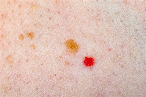 Tiny Red Blood Spots On Skin – Austra Health