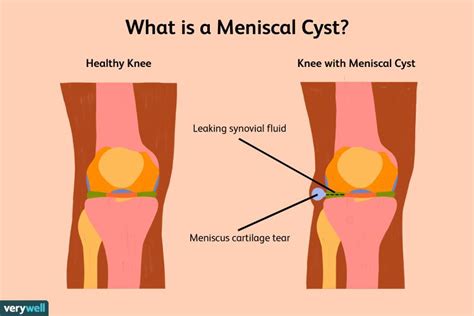 Meniscal Cysts: Symptoms, Causes, Diagnosis, and Treatment