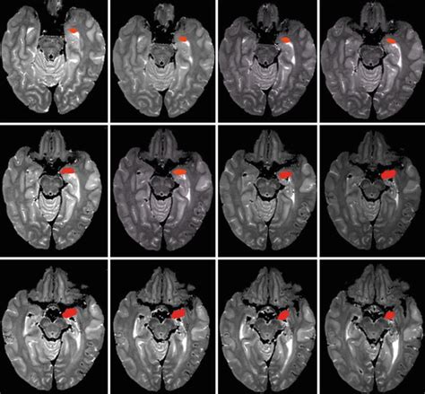 Amygdala Mri Sagittal