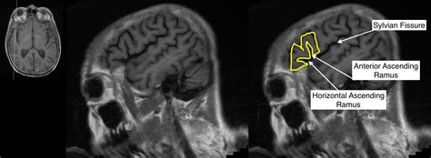 Superior Frontal Gyrus Mri