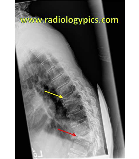 Thoracic Spine Compression Fractures – Vertebra Plana | RADIOLOGYPICS.COM