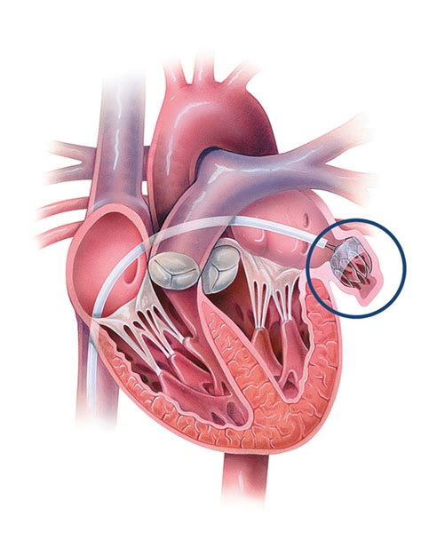 Left Atrial Appendage Closure Procedures | Johns Hopkins Medicine