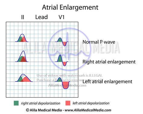 Alila Medical Media | Atrial enlargement ECG | Medical illustration