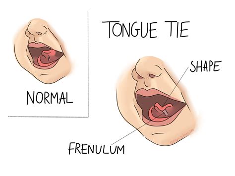 Tongue Tie - Beth Forrest Osteopathy