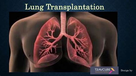 Lung transplantation surgery